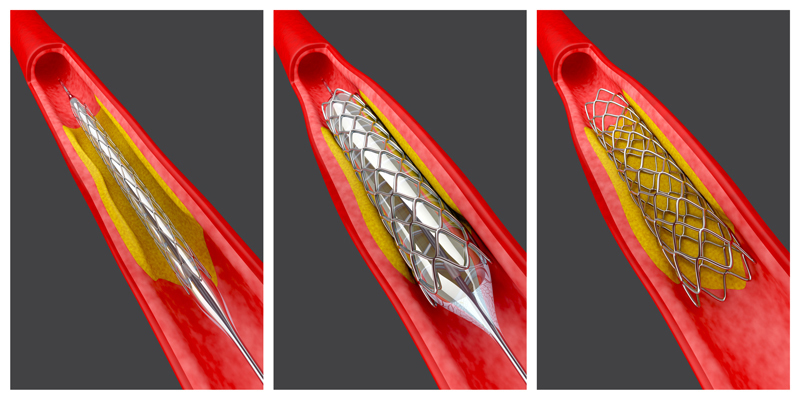 Coronary stent artery plaque blockage 3D illustration