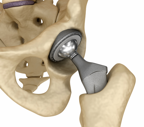 Hip replacement titanium implant