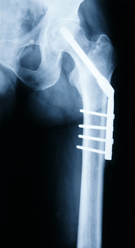 X-ray of a hip with titanium implant and screws